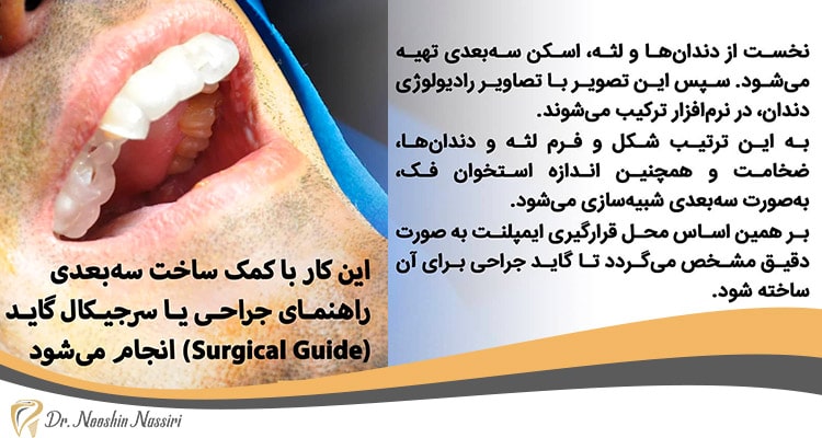 مراحل کاشت ایمپلنت دندان در مطب دکتر نصیری