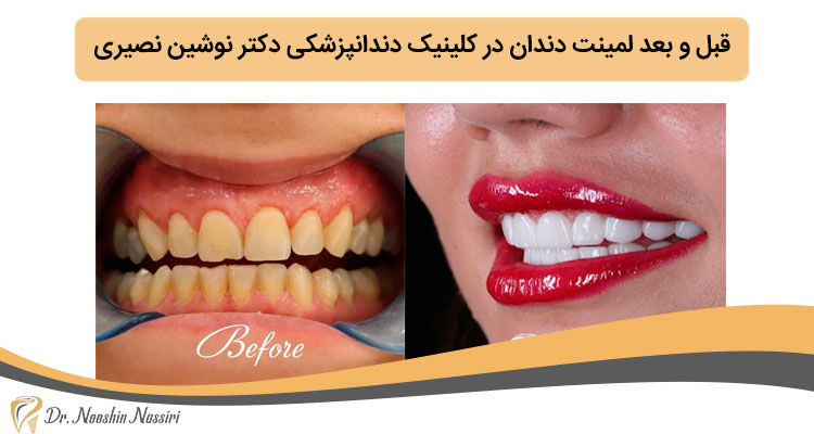 قبل و بعد لمینت دندان در کلینیک دندانپزشکی دکتر نوشین نصیری