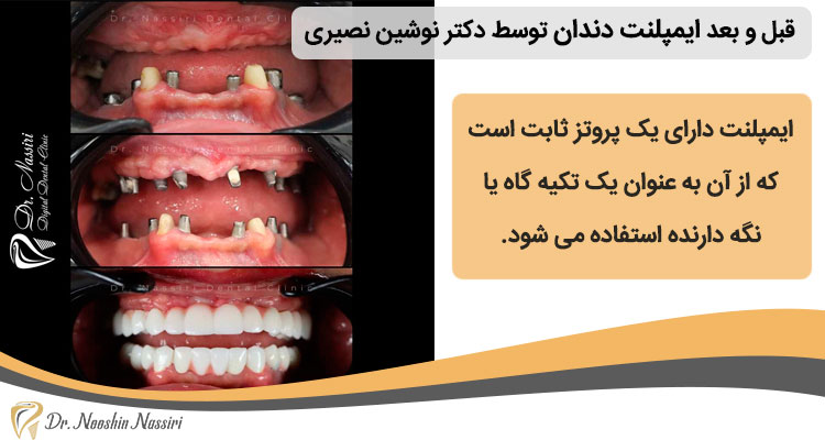 قبل و بعد ایمپلنت دندان توسط دکتر نوشین نصیری