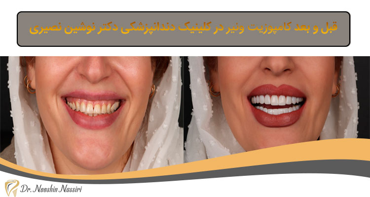 عکس قبل و بعد کامپوزیت ونیر دندان