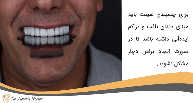 شرایط مینای دندان برای لمینت دندان