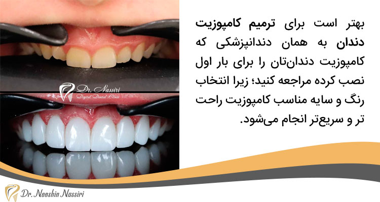 ترمیم کامپوزیت دندان توسط دندانپزشک