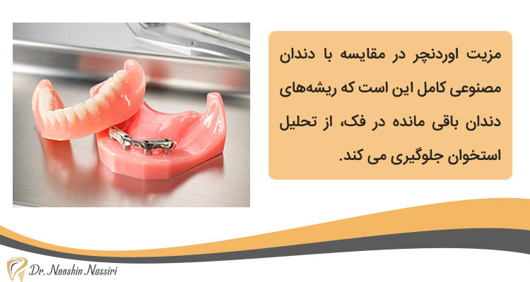 مزیت پروتز دندان اوردنچر