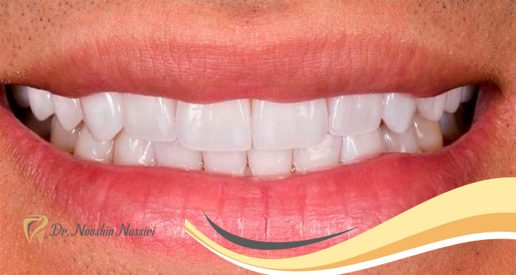 درصد موفقیت کاشت ایمپلنت دندان