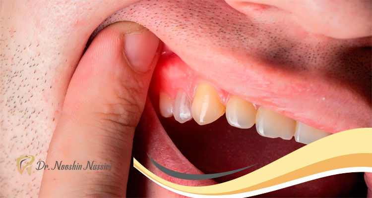 کاهش ورم دندان