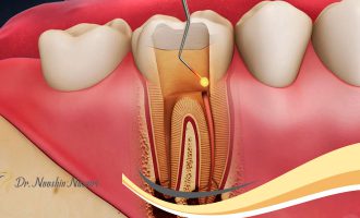 کشتن عصب دندان در خانه / عصب کشی دندان در خانه